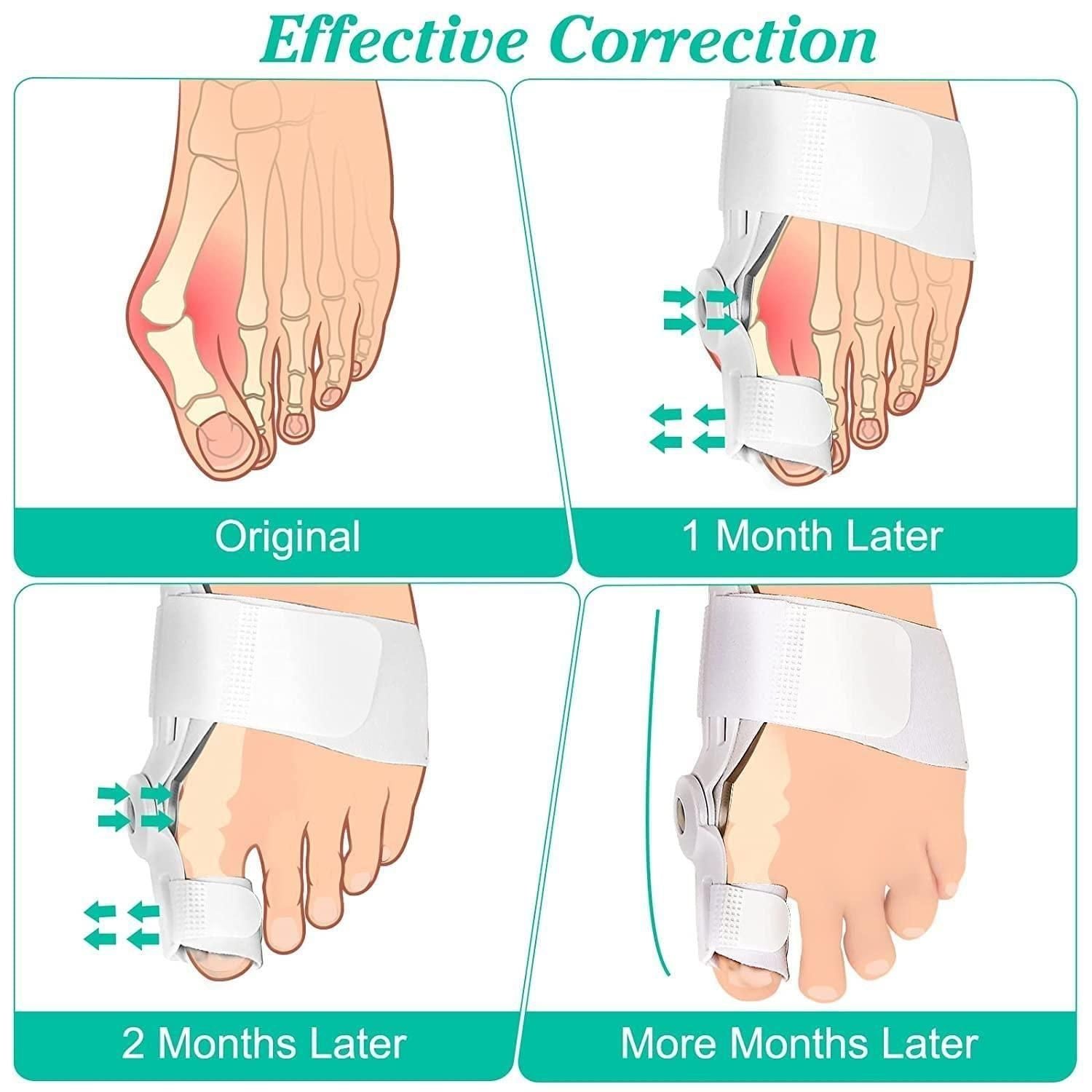 Roposo Clout Silicone Toe Separator For Adults Bunion Corrector Splint Kit For Toe - view 3
