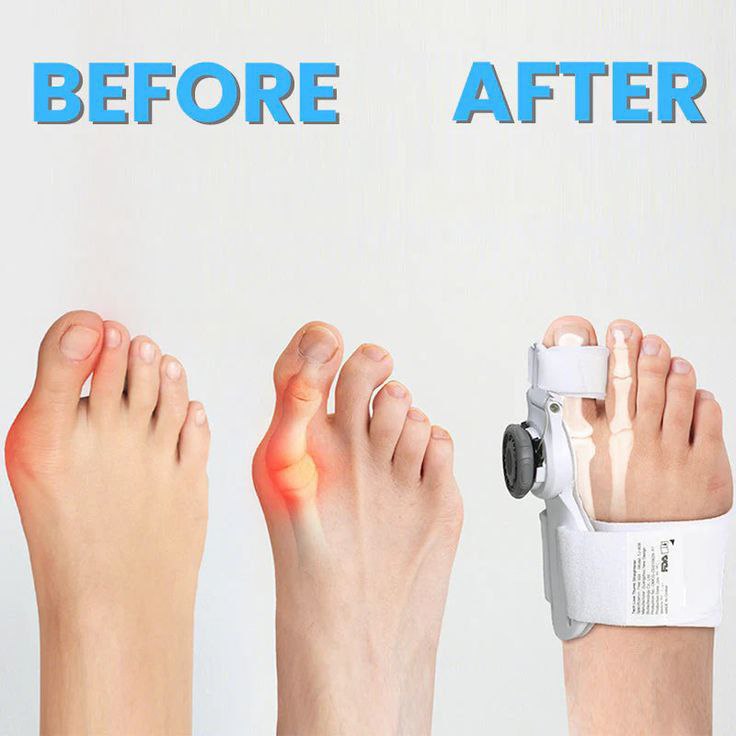 Catterton Effective Adjustable Toe Corrector